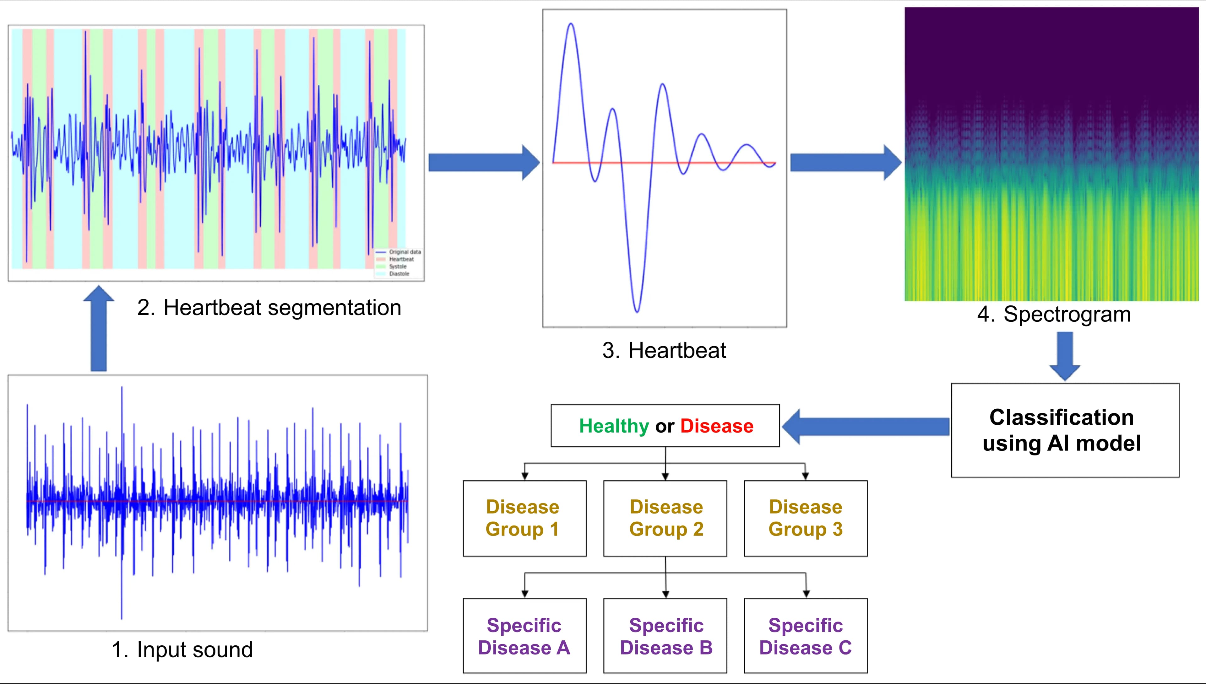 Smart AI for diagnosing heart diseases by sound